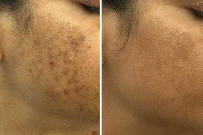 Acne/PIH Result